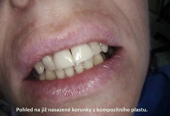 Kompozitní plast-fasety | LPdental.cz