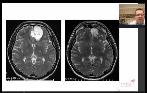 Neurochirurgie a mozkové nádory - David Netuka