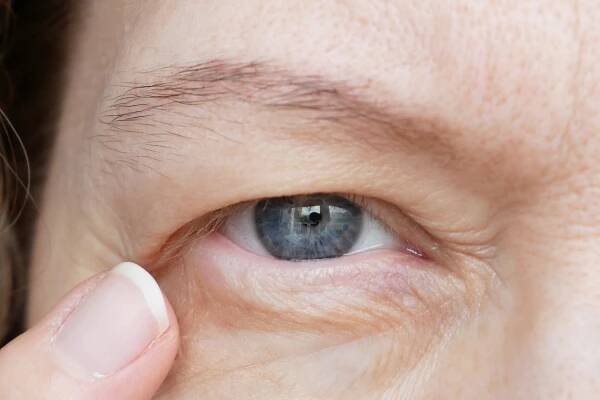 Ptosis Droopy Eyelid Surgery