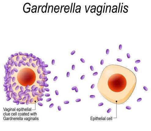 vaginální epiteliální stopa buňka potažená gardnerella vaginalis. - vulvo vaginitis stock ilustrace