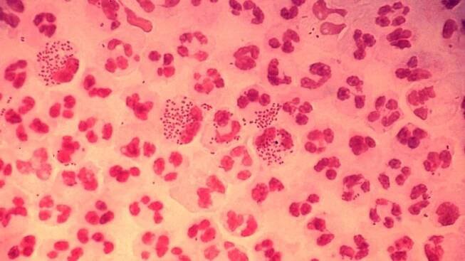 S kapavkou agresivnější než virus HIV si poradíme, tvrdí lékaři - Novinky