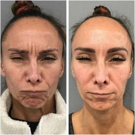 Botox los angeles before and after