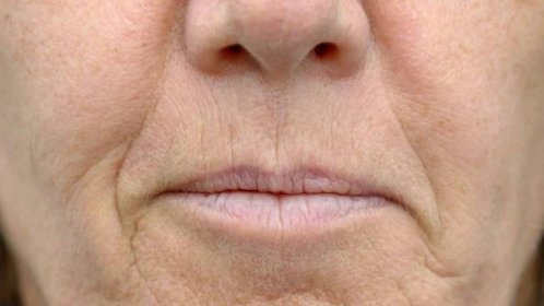 Vyhlazení vrásek kolem úst a nosu bez drahých procedur: Obličejová gymnastika a kostka ledu