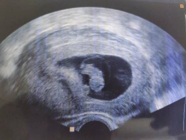 Fotky z ultrazvuku 8. - 9. týden. Pošlete fotky, prosím? - Modrý koník
