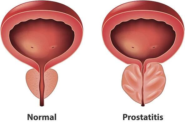 symptoms causes prostatitis men’s health normal vs prostatitis
