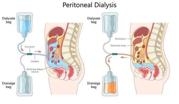 Jak funguje peritoneální dialýza, včetně umístění katetru, přítoku dialýzy a odvodnění z diagramu peritoneální dutiny ručně kreslené schématické rastrové ilustrace. Lékařská věda vzdělávání — Stock obrázek