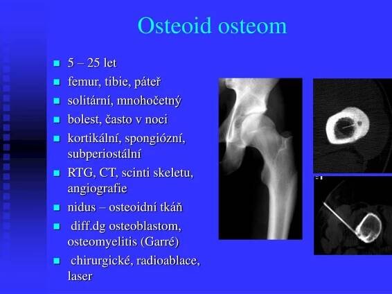 PPT - Benigní kostní nádory a afekce PowerPoint Presentation, free download - ID:4181870