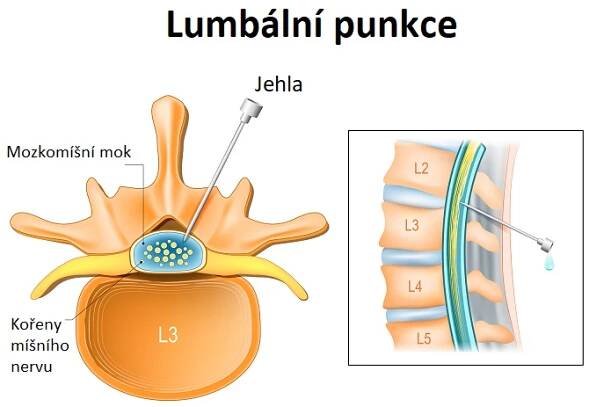 Lumbální punkce (vyšetření mozkomíšního moku - ilustrace