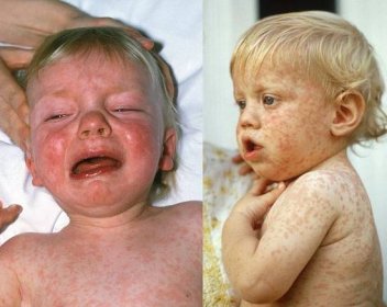 Epidemii spalniček do Česka zavlekli Ukrajinci. Změní se očkovací kalendář?