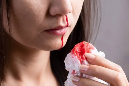 Krvácí vám často z nosu? Sledujte příznaky, některé mohou znamenat vážnou nemoc