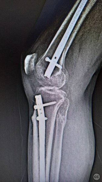Polytrauma femoral shaft, basicervical, and open tibia fracture