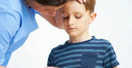 Plané neštovice mívají v dětství mírný průběh, u dospělých mohou mít fatální následky