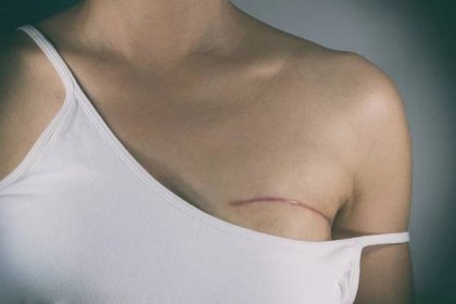 Žena po ablaci prsu