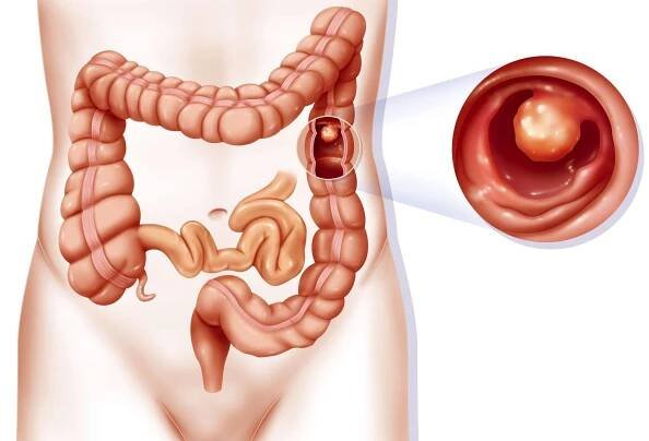 Post-Operative Instructions After Colon Polyp Removal