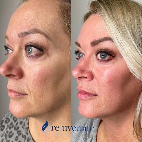 Cheek Filler Before & After - Rejuvenate Wellness & Med Spa