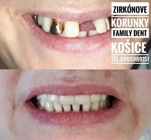 Zubné implantáty - Family Dent - Zubná ambulancia Košice