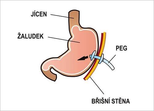 Enterální výživa (pediatrie) – WikiSkripta