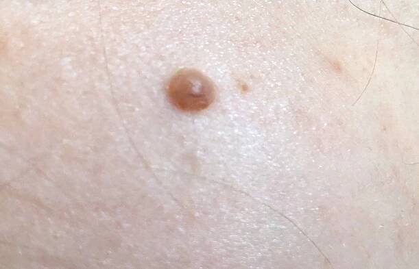 Spitz Nevus (ICD-11: 2F20 / ICD-10: D22) ⚠️ - Online AI Dermatologist