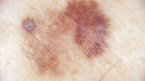 Vědci vyvinuli implantát likvidující kožní melanom