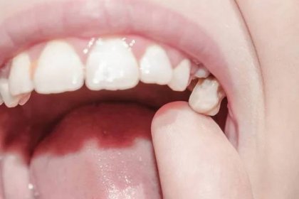 Primární zuby mléka padají na černou, nakaženou karí pro medicínu — Stock obrázek
