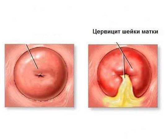 Cervicitis jako příčina cervikální eroze / Cervicitis