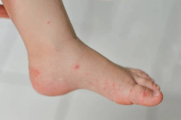 enterovirus noha rameno ústa vyrážka na těle dítěte cocksackie virus - nemoc rukou nohou a úst - stock snímky, obrázky a fotky