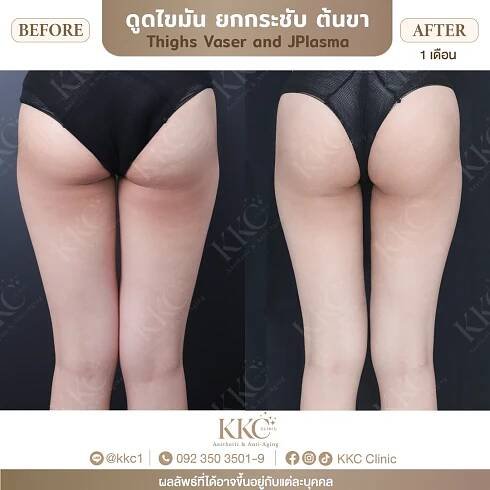 J-Plasma Skin Tightening in Bangkok | KKC Clinic