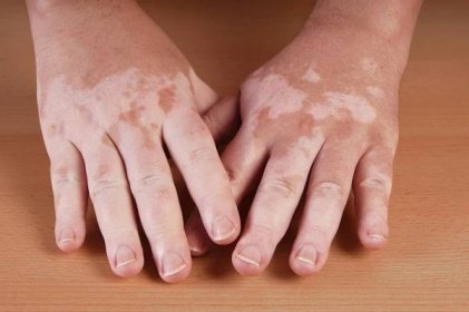 Vitiligo – nedostatek pigmentace v kůži a jak ho řešit