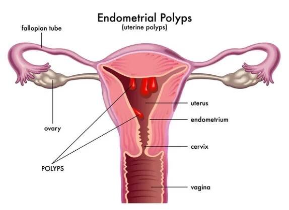 Vektorová ilustrace endometriálních polypů — Ilustrace