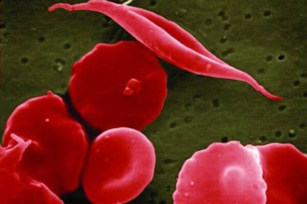 improving-health--genetic-diseases.jpg