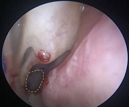 Balloon Sinuplasty - SinusHealth