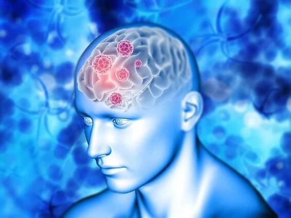 Morning Stroke: What Are The Tell-Tale Signs Of A Fatal Brain Stroke?