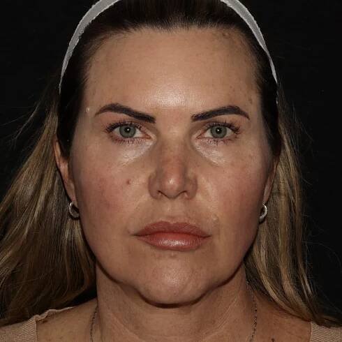 Emface After hbj. Non-surgical facelift. mini facelift. needle free face lift. dermatology of the rockies. longmont. Boulder. Erie. Best medical spa near me.