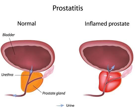 prostatitis_shutterstock_127210970-[Converted]