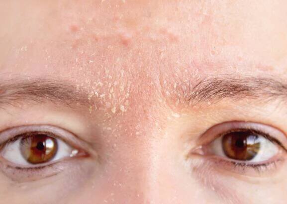 av_carnets-experts_acne_xerose-induite_5x4