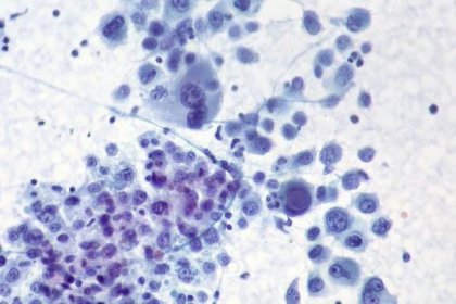 Melanoma visto por el microscopio