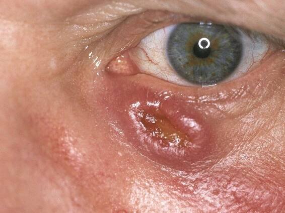 Lymphomatoids papulose