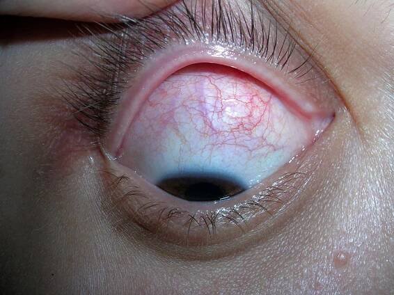 Scleritis - Eye Disorders - MSD Manual Consumer Version