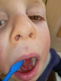 Dětské nemoci | Co to je? Útvar v puse pod jazykem - dítě