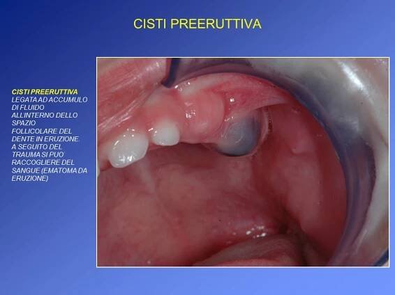 CISTI PREERUTTIVA 1