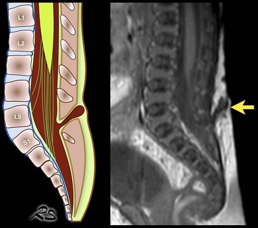 The Radiology Assistant : Ultrasound of the Neonatal spine