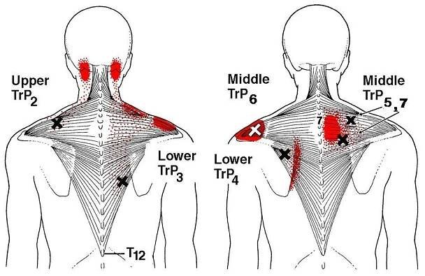 Trapezius referral pattern