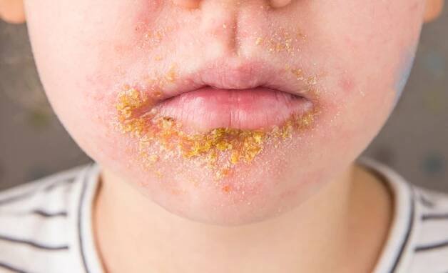 5-leté dítě s impetigo (nonbullous impetigo) čarodějnice je bakteriální infekce, která zahrnuje povrchovou kůži. žluté stěry na infikované oblasti. - impetigo - stock snímky, obrázky a fotky