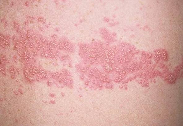 Komplikace dětských infekcí herpes zoster / Články