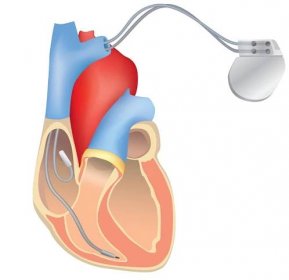 kardiostimulátor v práci. průřez anatomií lidského srdce s funkčním implantabilním kardioverter defibrilátorem. - kardiostimulátor stock ilustrace