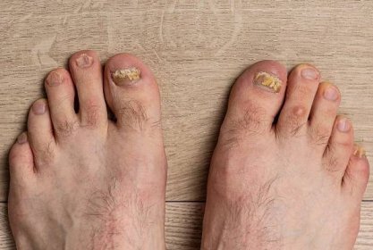 Jak se zbavit plísně nohou i bez dermatologa - BYLINKY DNES