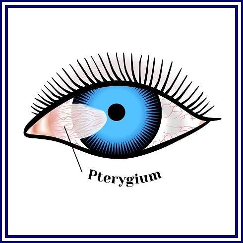 Pterygium