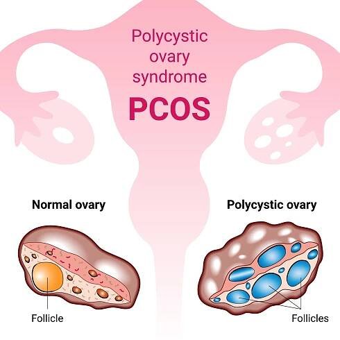 What is PCOS?