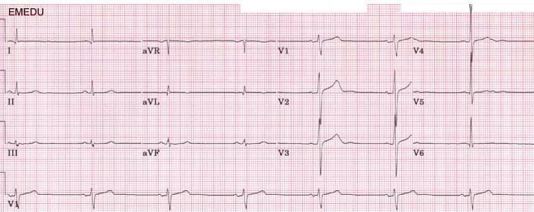 Sinusová bradykardie - EKG | Medicína, nemoci, studium na 1. LF UK
