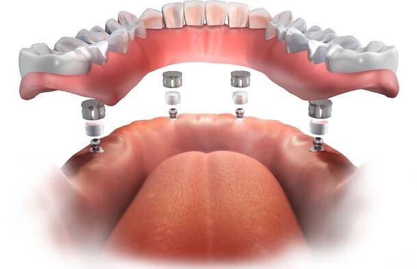 Dolní implantát podporuje kompletní zubní protézu. Všechny na 4 implantáty. Nástavba kulové nástavby. 3D ilustrace. — Stock obrázek